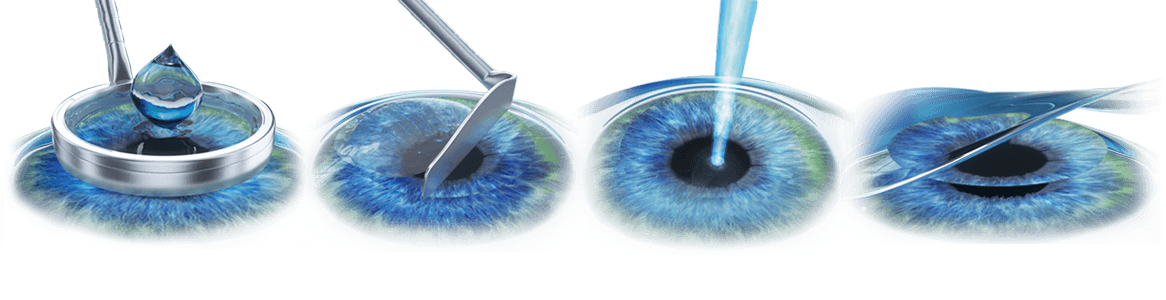 عملية الليزك بعد سن الأربعين 