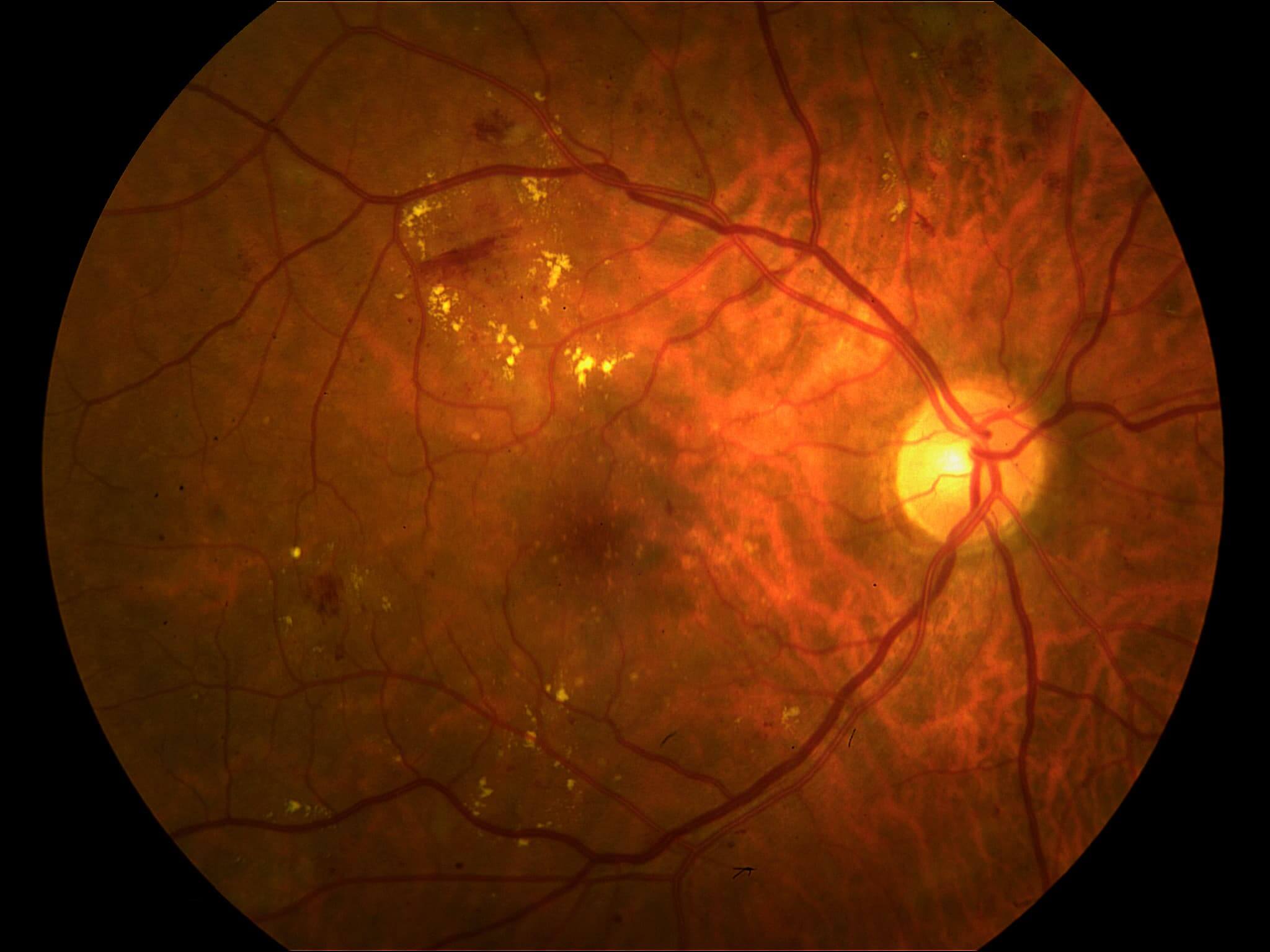 Diabetic retinopathy