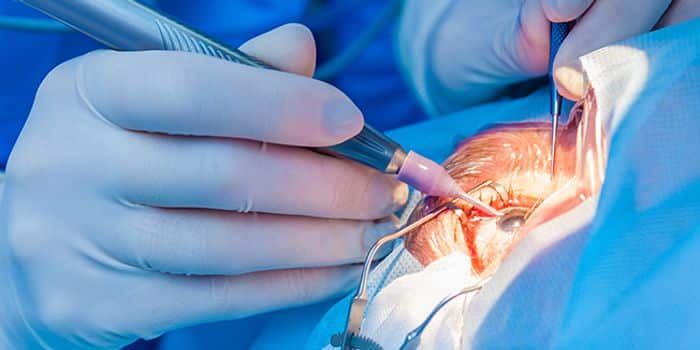 سعر عملية تصحيح النظر