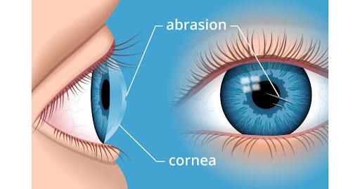 Corneal abrasion 
