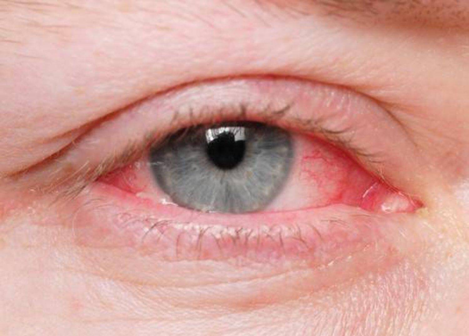 تعرف على التهاب ملتحمة العين اسباب 