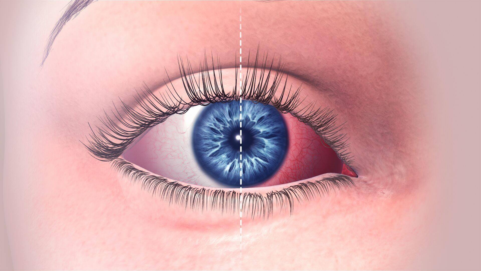 ما هو التهاب ملتحمة العين