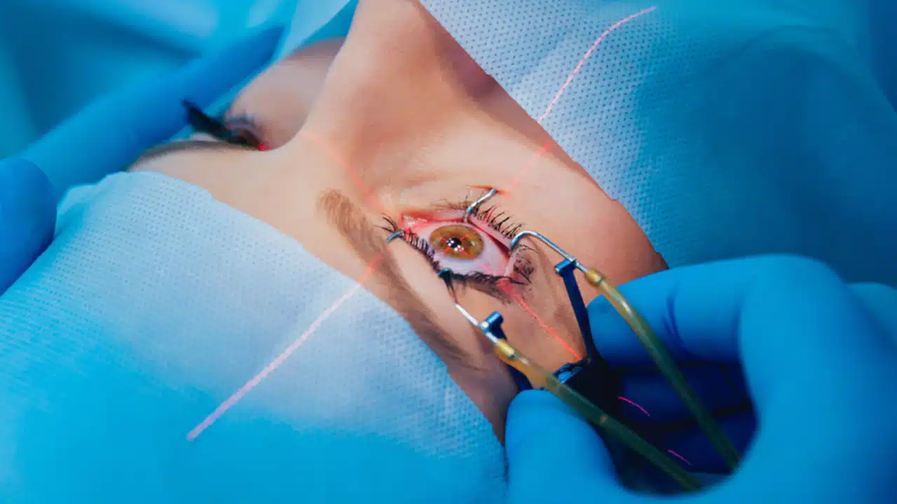 عملية الليزر السطحي prk