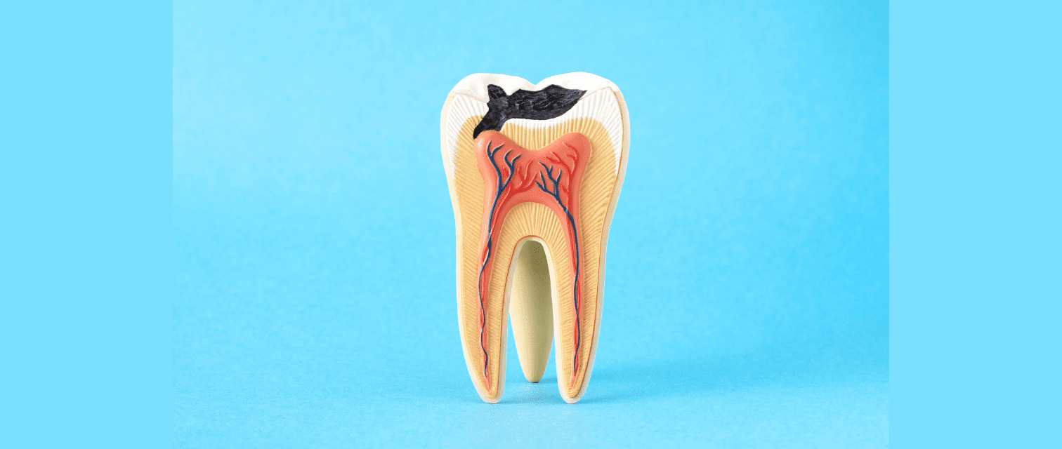 ألم في الضرس عند الضغط عليه بعد حشو العصب