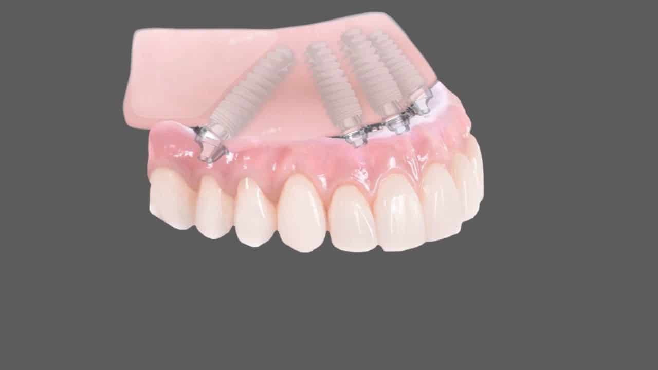 زراعة الأسنان