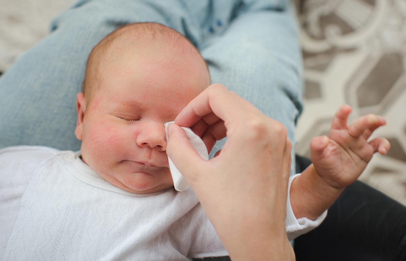 أسباب انسداد القناة الدمعية عند الاطفال