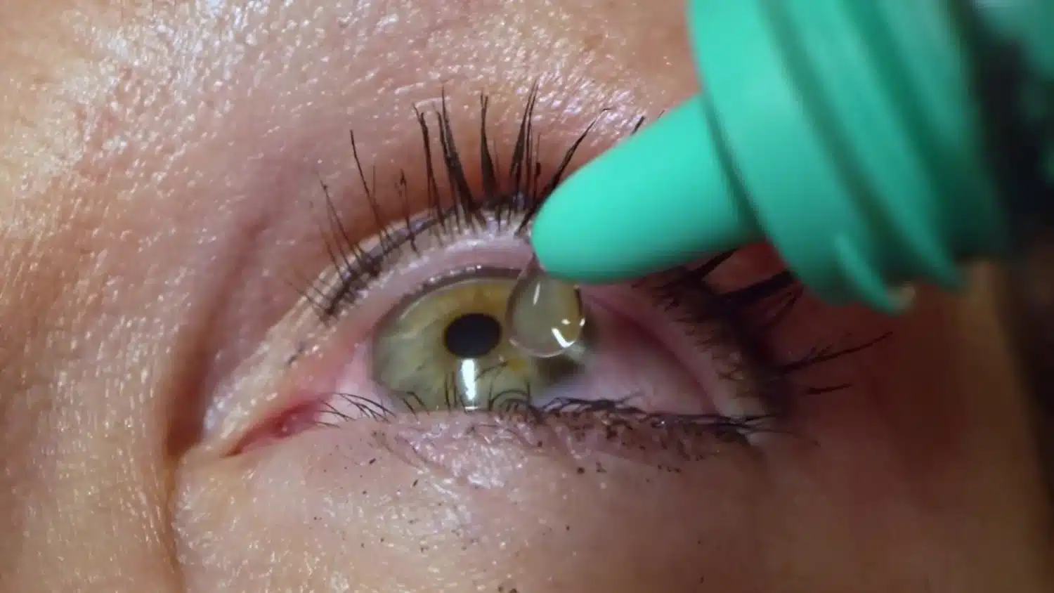 بعد عملية تصحيح النظر