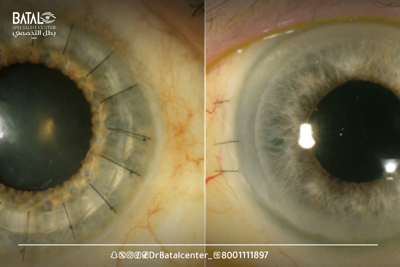 تجربتي مع عملية زراعة القرنية