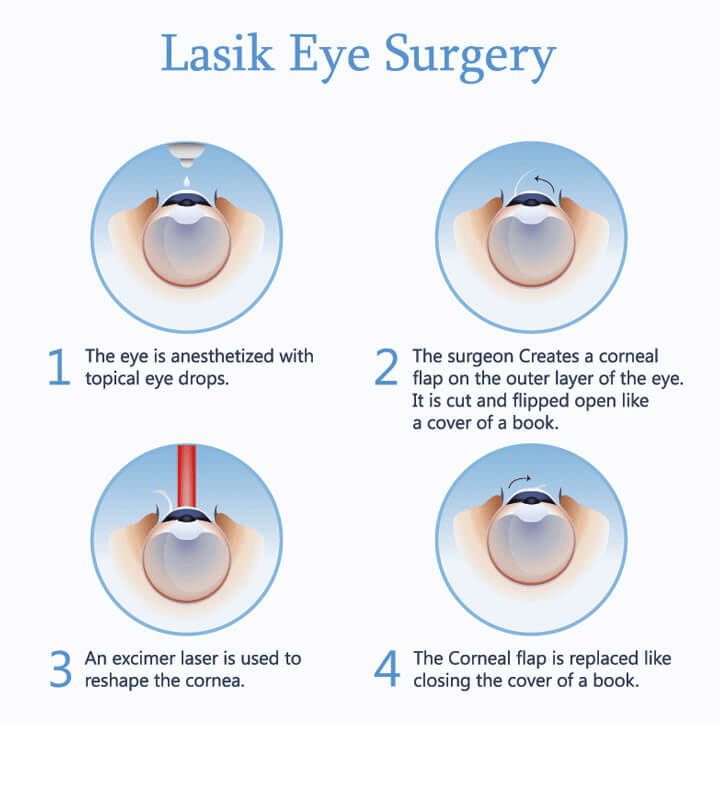 How Laser Eye Surgery Works: A Step-by-Step Breakdown?
