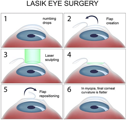 What to Expect During LASIK Surgery?