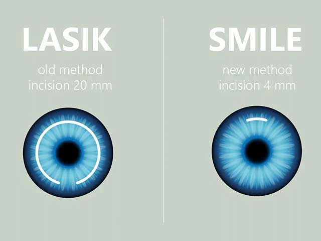 How Doctors Determine the Best Laser Eye Surgery for You?
