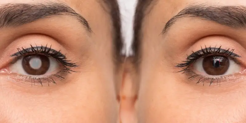 تعليمات بعد عملية المياه البيضاء