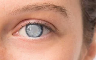 تعليمات بعد عملية المياه البيضاء