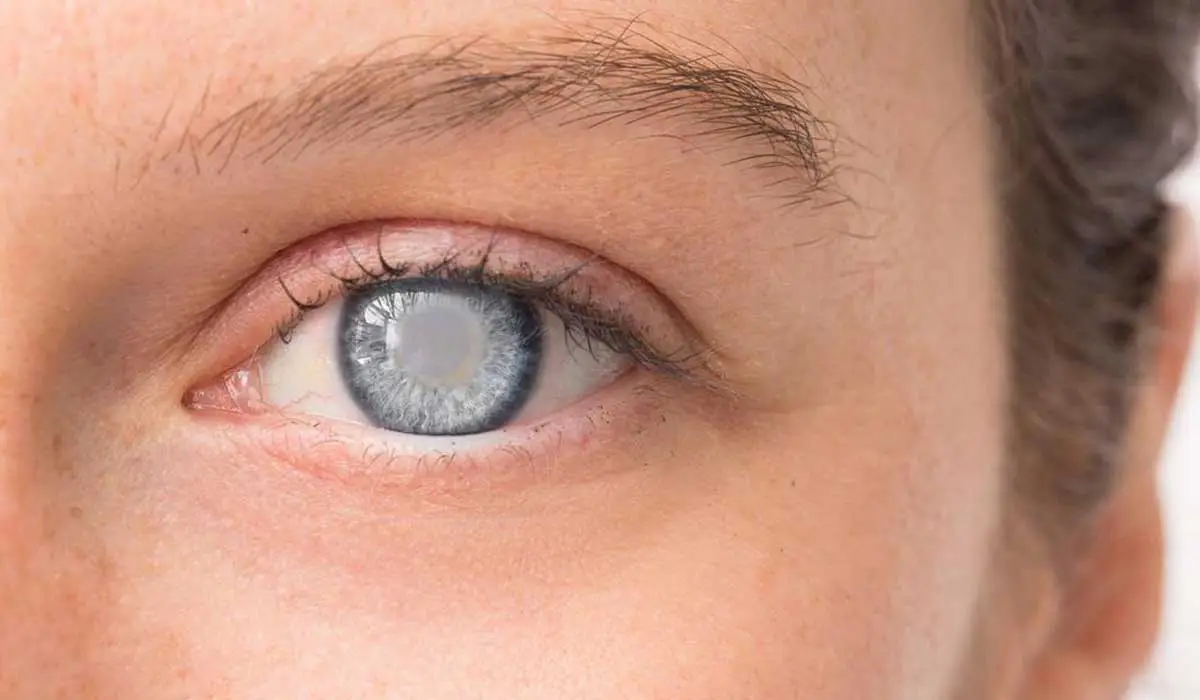 تعليمات بعد عملية المياه البيضاء