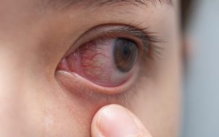 حساسية العين