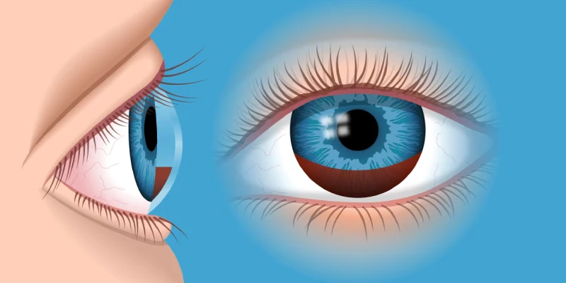 أنواع صداع العين