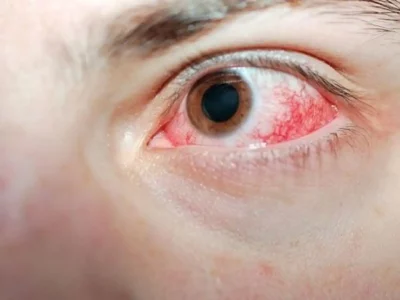 احمرار العين بالصور