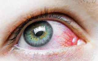 احمرار العين