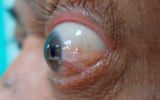 أسباب وأعراض وطرق علاج انتفاخ العين وتحت العين وتورم العين