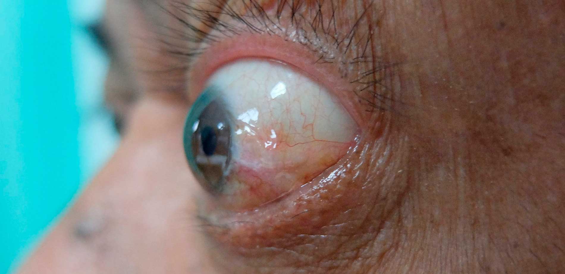 أسباب وأعراض وطرق علاج انتفاخ العين وتحت العين وتورم العين