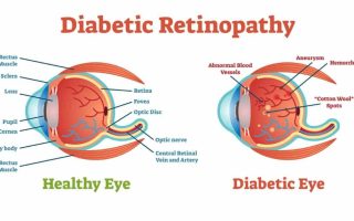 أعراض وعلاج اعتلال شبكية العين السكري