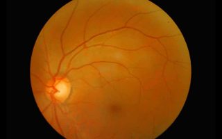 التهاب الشبكية الصباغي