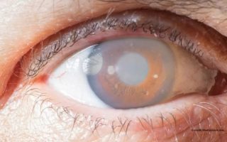 الجلوكوما أو الماء الأزرق في العين | أعراض أسباب وطرق العلاج