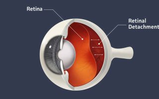 انفصال الشبكية أسباب | أعراض | علاج
