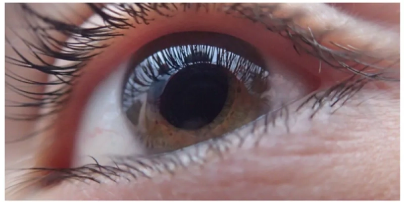 Visually Significant Cataract