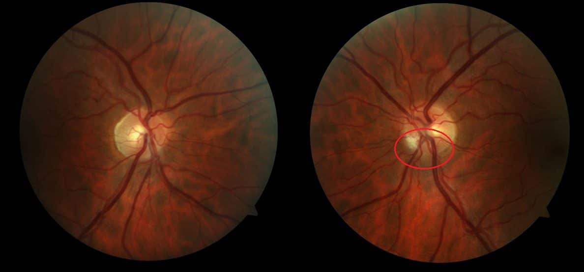 اعراض التهاب العصب البصري .. الأسباب والعلاج والأخطار