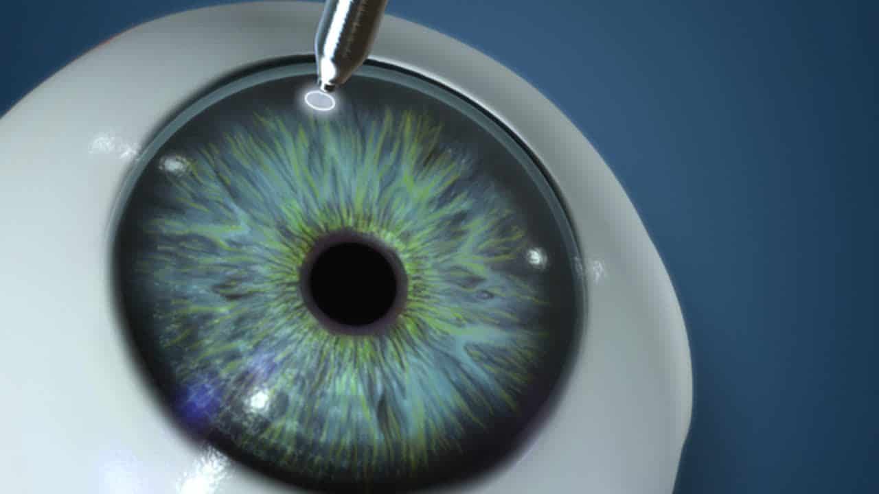 تكلفة زراعة القرنية