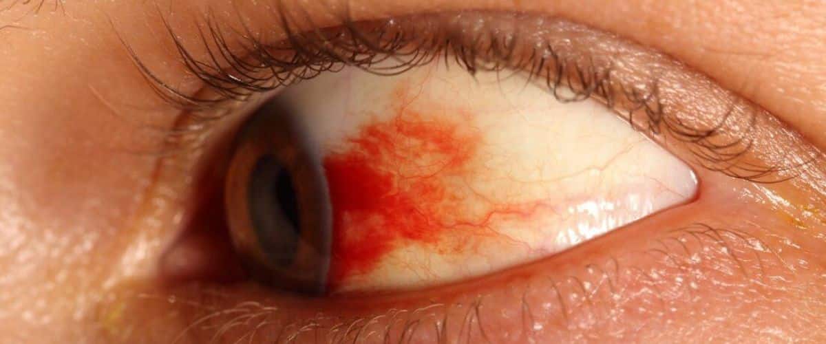 كيفية علاج تلف شبكية العين