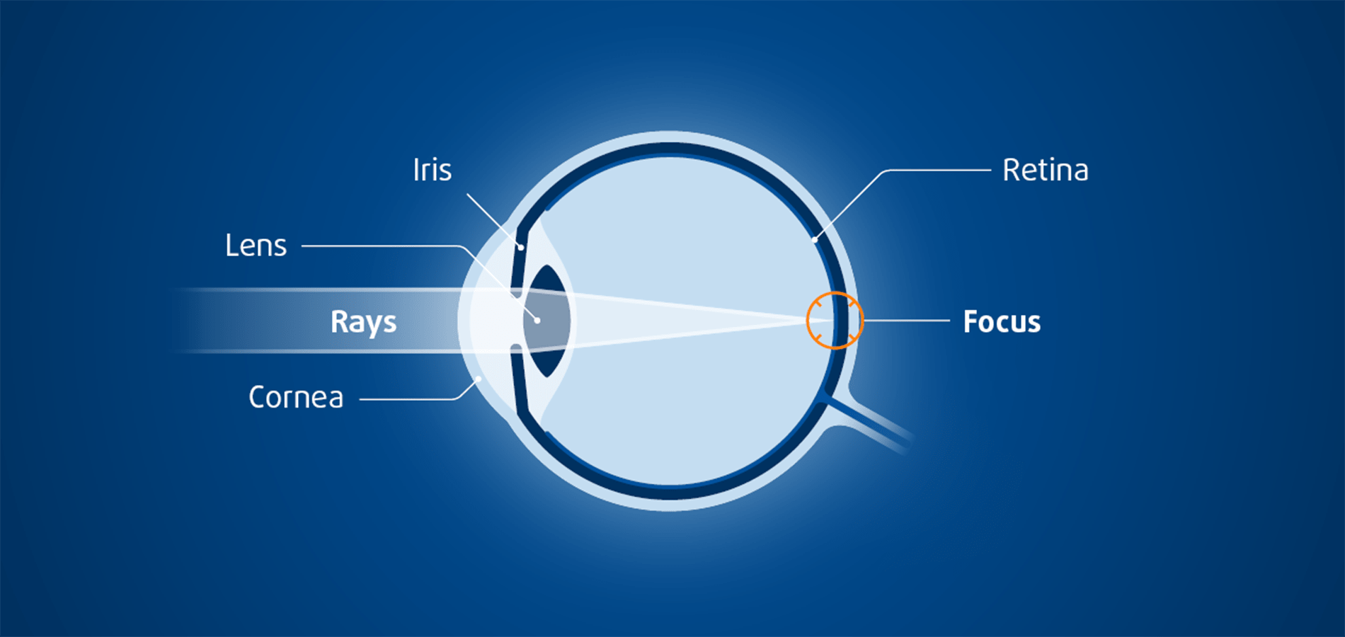 هل صحيح تستخدم عدسات لعلاج طول النظر