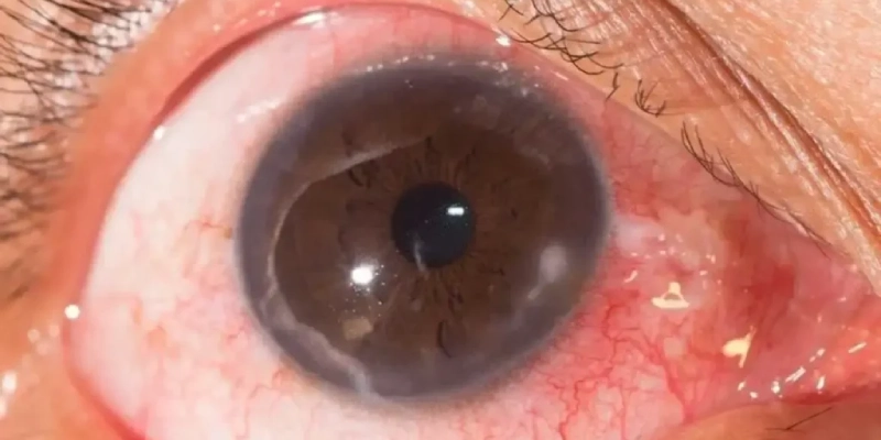  التهاب القرنية أو خدوش سطح العين