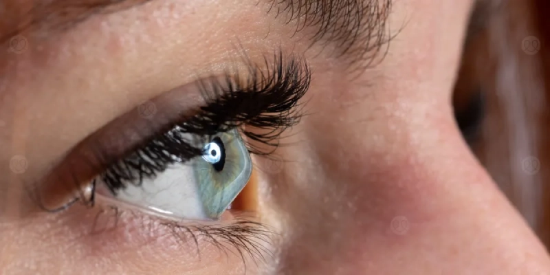 القرنية المخروطية