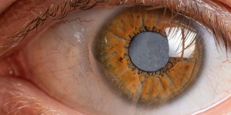 إعتام عدسة العين (الماء الأبيض)