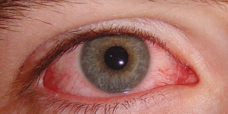 ارتفاع ضغط العين والجلوكوما