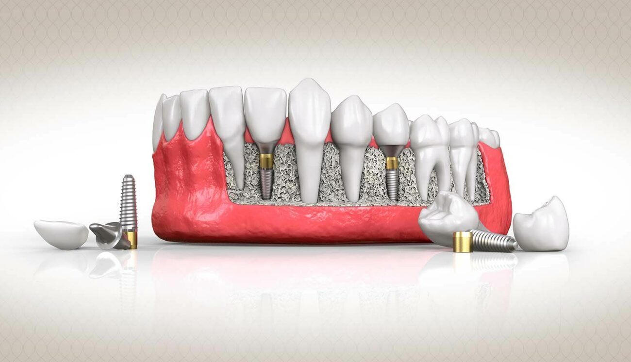 أنواع زراعة الأسنان واسعارها