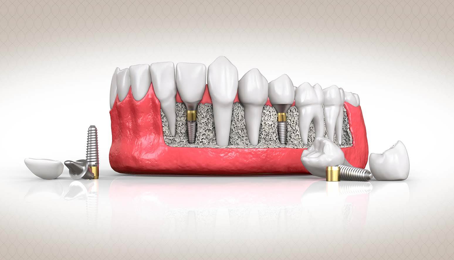 أنواع زراعة الأسنان واسعارها