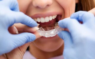 مدة تقويم الأسنان