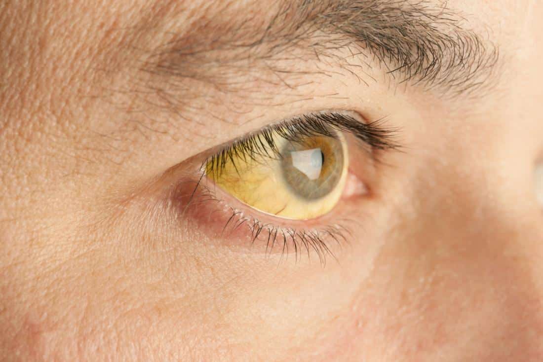 can cigarettes cause yellow eyes For my full video on eyes, watch my #IGLive from 6/11/25. , I discuss the various causes of yellow eyes, including alcohol overuse, viral hepatitis, gallstones, liver failure, smoking, Causes of Yellow Eyes: Symptoms,