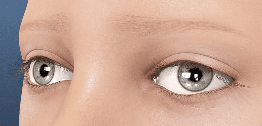 الغمش العين الكسولة