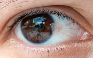 ظفرة العين Pterygium