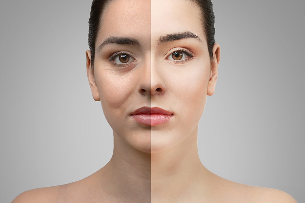 جراحة تجميل جفون العين