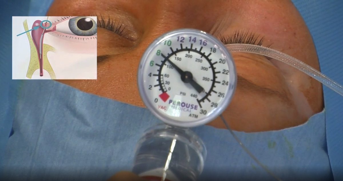 كل ما ترغب بمعرفته حول عملية انسداد القناة الدمعية