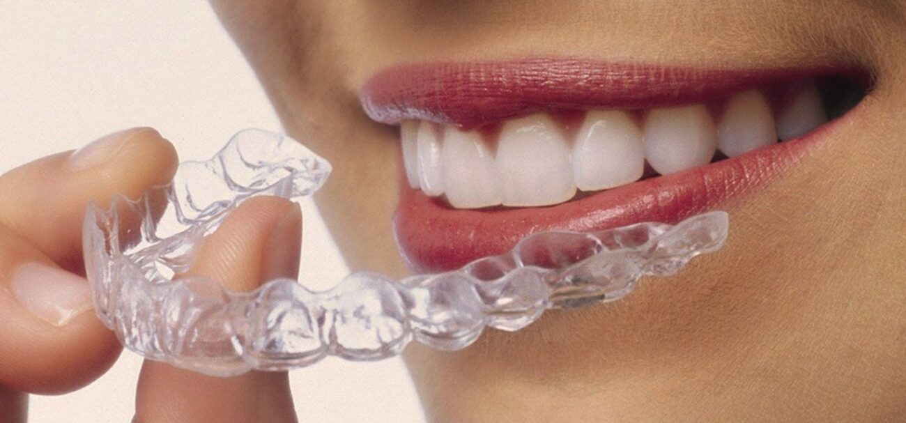 تقويم الأسنان مقابل اقواس الاسنان