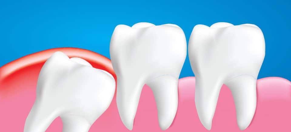 صحة الأسنان و اضراس العقل