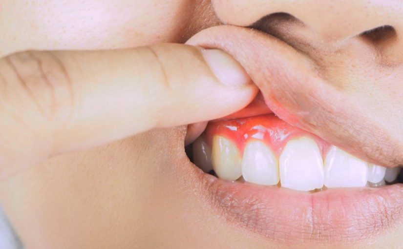 علاج اللثة المنتفخة