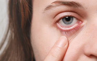 علاج جفاف العيون بعد الليزك