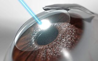 كيفية اختيار جراح الليزك